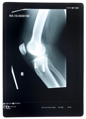 Female athletes are more prone to ACL tears than their male counterparts.