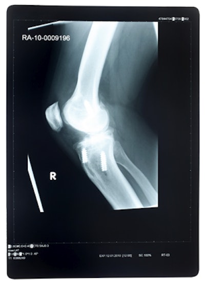 Female athletes are more prone to ACL tears than their male counterparts.