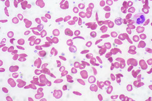 sickle-cell-cc-ed-uthman