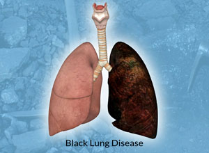 black-lung-disease