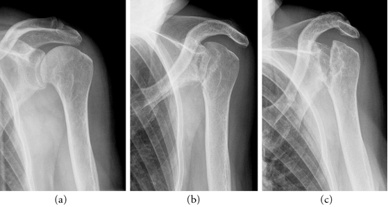 Vanishing Bone Disease