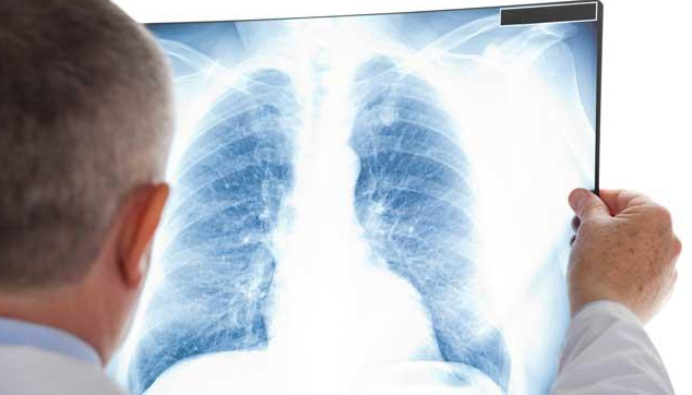 Legionnaires Disease